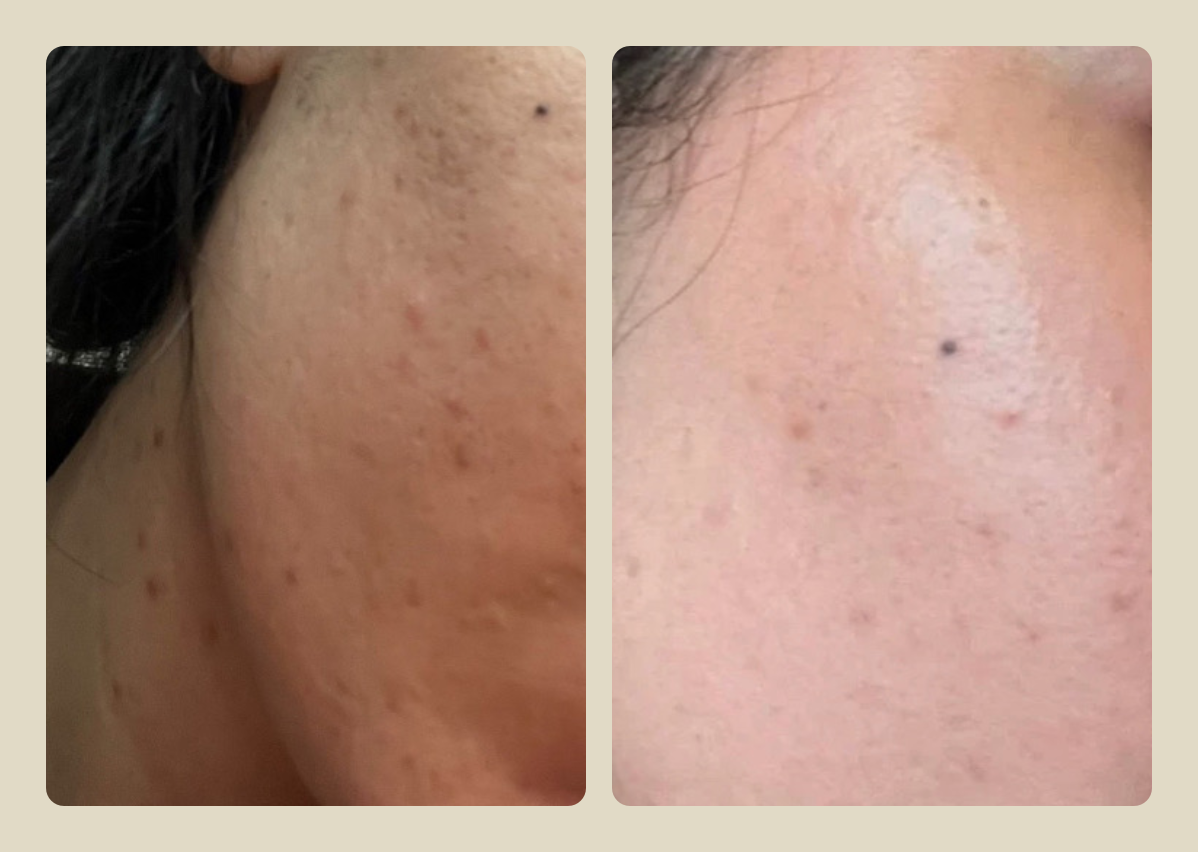 Before and after — skin texture