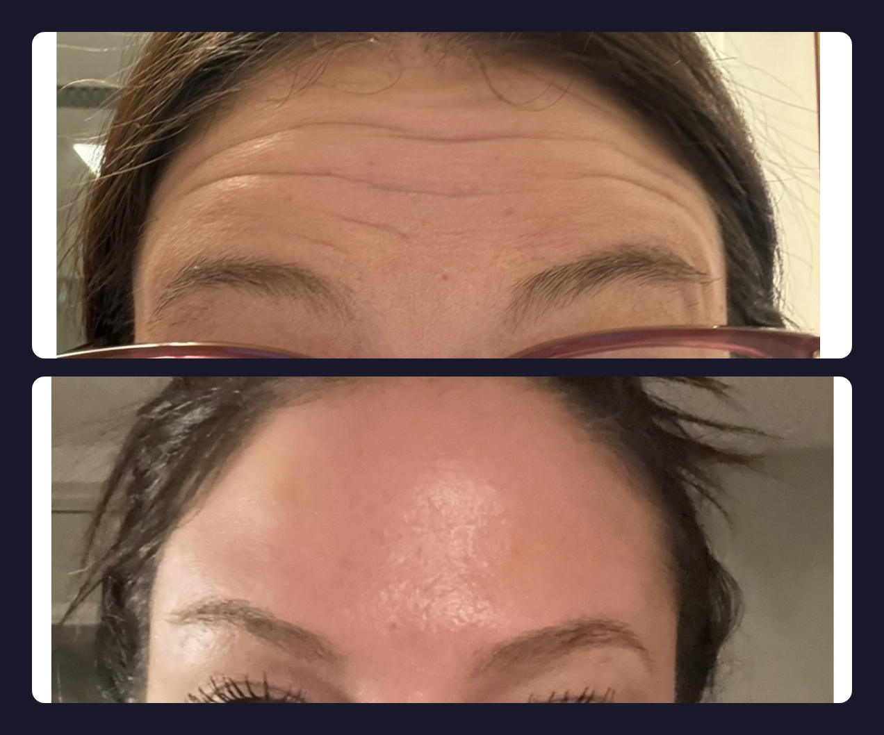 Before and after — forehead lines