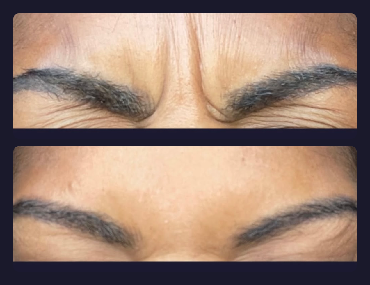 Before and after — frown lines