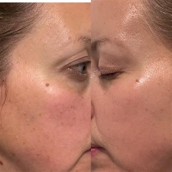Before and after — under-eye